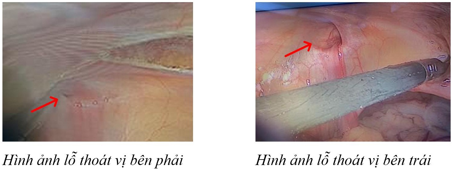 thoat vi ben nu gioi gap de roi vao truong hop bat thuong gioi tinh hinh 1