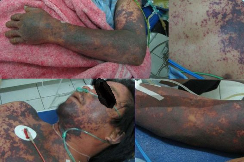 Hình ảnh bệnh nhân bị nhiễm khuẩn huyết do liên cầu lợn (ảnh nguồn Bệnh viện Bạch Mai).