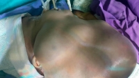 Phẫu thuật khối u bạch huyết khổng lồ cho bé trai 1 tháng tuổi