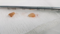 Phẫu thuật cứu sống bé trai 2 tuổi bị hóc hạt đậu phộng khi ăn xôi