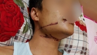 Uông Bí, Quảng Ninh: Nam thanh niên “thập tử nhất sinh” vì bị dây viễn thông ngoài đường siết cổ