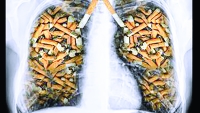 Thuốc lá – Tác nhân hàng đầu gây ung thư phổi