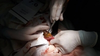 Hà Tĩnh: Bệnh nhân tắc ruột vì ăn hồng ngâm khi đói