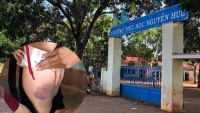 Đắk Lắk: Nữ sinh lớp 4 bị cô giáo đánh bầm mông