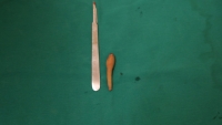 Hà Nội: Phẫu thuật thành công cho bé gái 5 tháng có 'đuôi' bẩm sinh dài 9,5cm