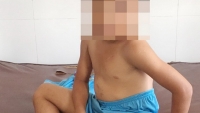 Sóc Trăng: Bé trai 6 tuổi bị cha dượng bạo hành dã man