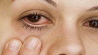 Nốt ruồi trong mắt - nguy cơ phát triển thành ung thư mắt