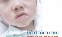 Lào Cai: Kịp thời gắp con vắt suối dài 10 cm sống 2 tháng trong mũi bé trai 4 tuổi