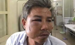 Thừa Thiên Huế: Khởi tố chủ quán cà phê đánh nhân viên Công ty cây xanh vỡ xương hàm
