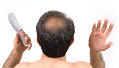 Chữa bệnh hói đầu bằng cách sử dụng da nhân tạo được “nuôi”