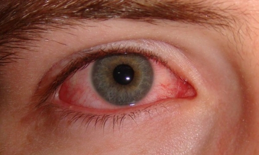 Cẩn trọng với triệu chứng đỏ mắt, đau mắt hậu COVID-19