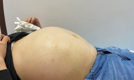 Bệnh viện Phụ sản Hà Nội: Phẫu thuật thành công u nhầy buồng trứng nặng 8 kg