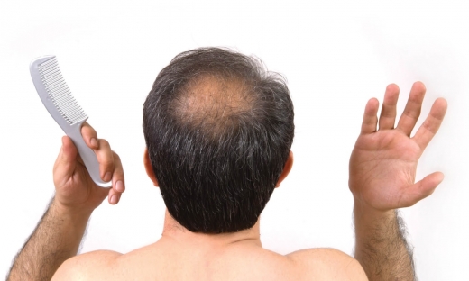 Chữa bệnh hói đầu bằng cách sử dụng da nhân tạo được “nuôi”